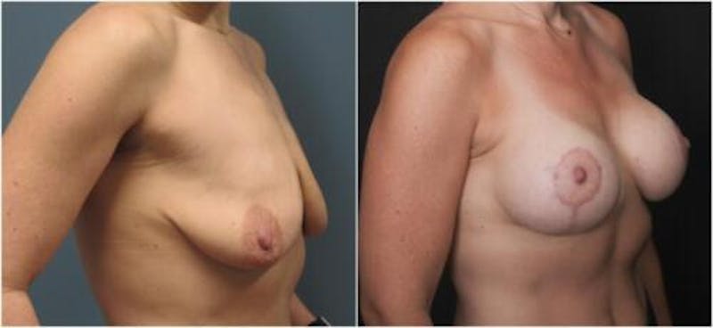 Breast Augmentation Before & After Gallery - Patient 113480 - Image 2