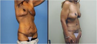 Abdominoplasty Before & After Gallery - Patient 269378 - Image 2