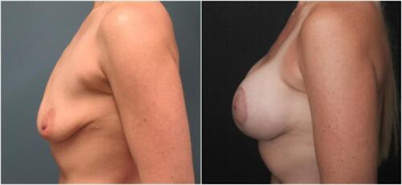 Breast Augmentation Before & After Gallery - Patient 113480 - Image 3