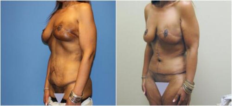 Abdominoplasty Before & After Gallery - Patient 269378 - Image 3