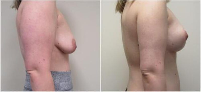 Breast Augmentation Before & After Gallery - Patient 169694 - Image 1