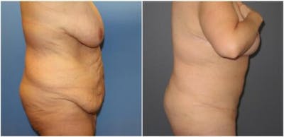 Abdominoplasty Before & After Gallery - Patient 182708 - Image 1
