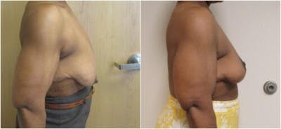 Breast Lift Before & After Gallery - Patient 360767 - Image 1