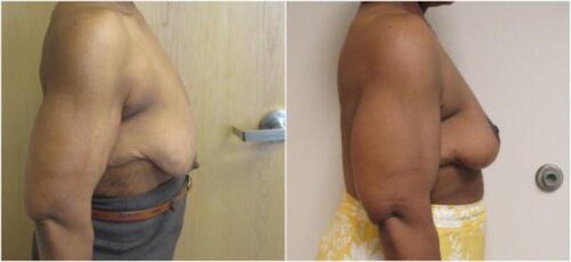 Breast Lift Before & After Gallery - Patient 360767 - Image 1