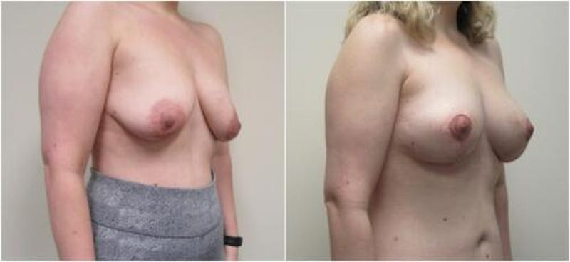 Breast Augmentation Before & After Gallery - Patient 169694 - Image 2