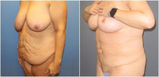 Abdominoplasty Before & After Gallery - Patient 182708 - Image 2