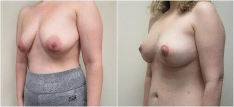 Breast Augmentation Before & After Gallery - Patient 169694 - Image 3