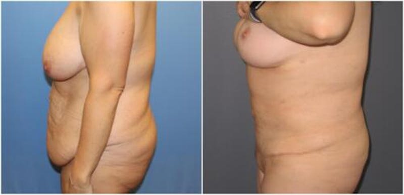 Abdominoplasty Before & After Gallery - Patient 182708 - Image 3