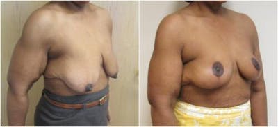 Breast Lift Before & After Gallery - Patient 360767 - Image 2