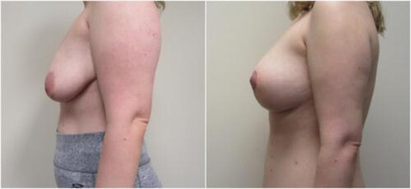 Breast Augmentation Before & After Gallery - Patient 169694 - Image 4