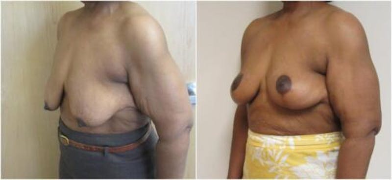 Breast Lift Before & After Gallery - Patient 360767 - Image 3