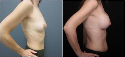 Breast Augmentation Before & After Gallery - Patient 605736 - Image 1