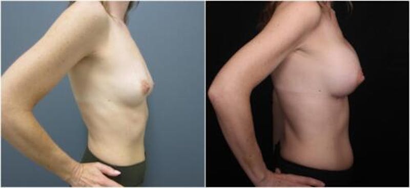 Breast Augmentation Before & After Gallery - Patient 605736 - Image 1