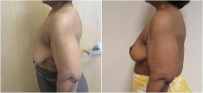 Breast Lift Before & After Gallery - Patient 360767 - Image 4