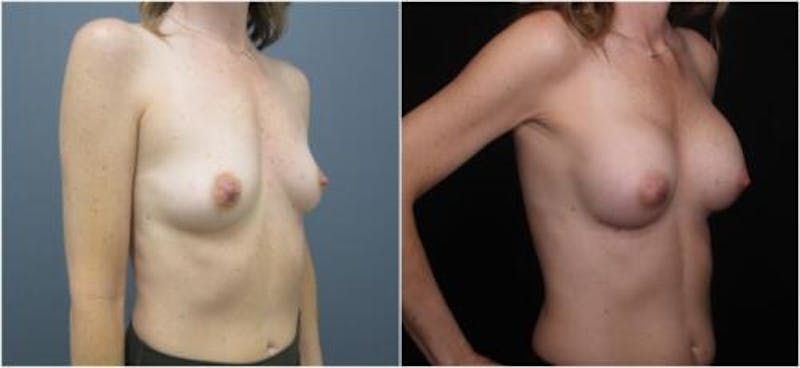 Breast Augmentation Before & After Gallery - Patient 605736 - Image 2