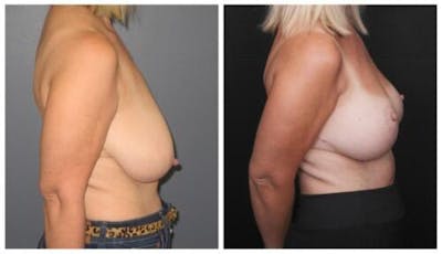 Breast Lift Before & After Gallery - Patient 412564 - Image 1