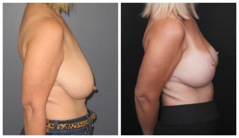 Breast Lift Before & After Gallery - Patient 412564 - Image 1