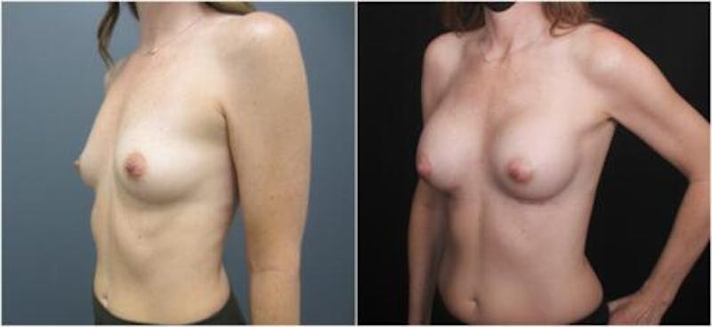 Breast Augmentation Before & After Gallery - Patient 605736 - Image 3