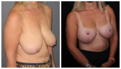 Breast Lift Before & After Gallery - Patient 412564 - Image 2