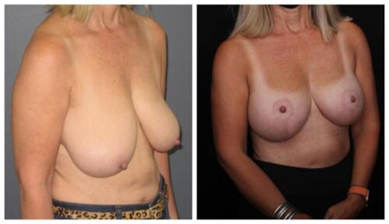 Breast Lift Before & After Gallery - Patient 412564 - Image 2
