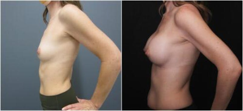 Breast Augmentation Before & After Gallery - Patient 605736 - Image 4