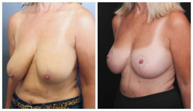 Breast Lift Before & After Gallery - Patient 412564 - Image 3