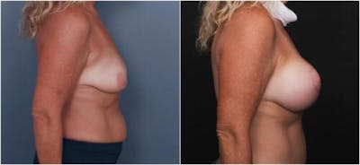 Breast Augmentation Before & After Gallery - Patient 298759 - Image 1