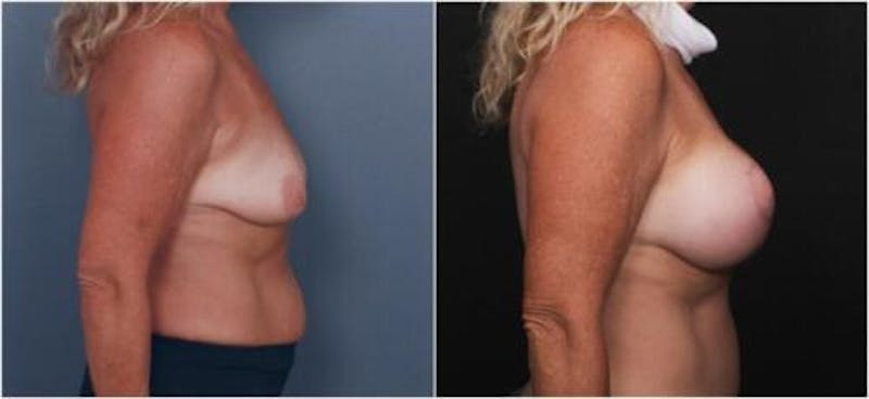 Breast Augmentation Before & After Gallery - Patient 298759 - Image 1