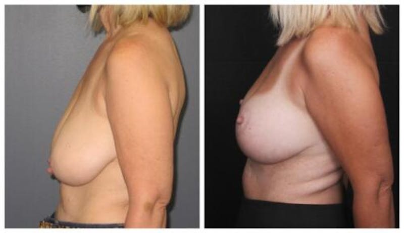 Breast Lift Before & After Gallery - Patient 412564 - Image 4