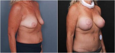 Breast Augmentation Before & After Gallery - Patient 298759 - Image 2