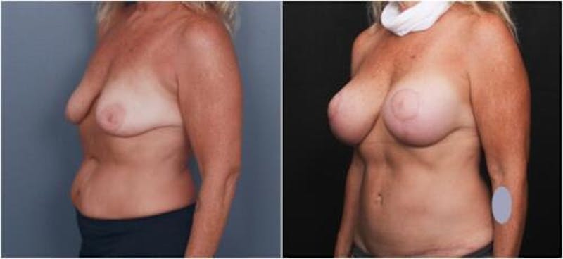 Breast Augmentation Before & After Gallery - Patient 298759 - Image 3
