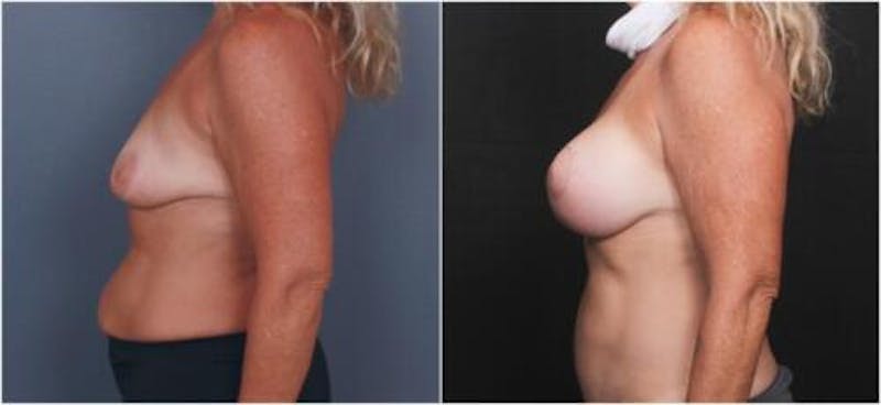 Breast Augmentation Before & After Gallery - Patient 298759 - Image 4