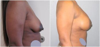 Breast Reconstruction Before & After Gallery - Patient 187840 - Image 1