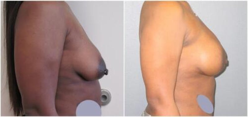 Breast Reconstruction Before & After Gallery - Patient 187840 - Image 1