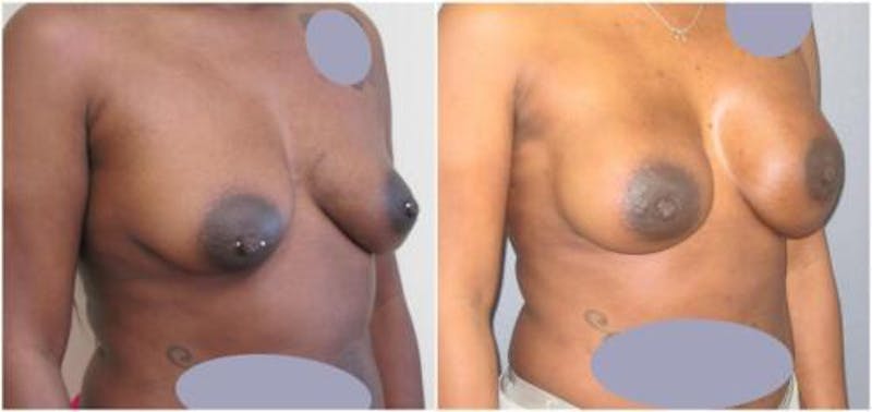 Breast Reconstruction Before & After Gallery - Patient 187840 - Image 2