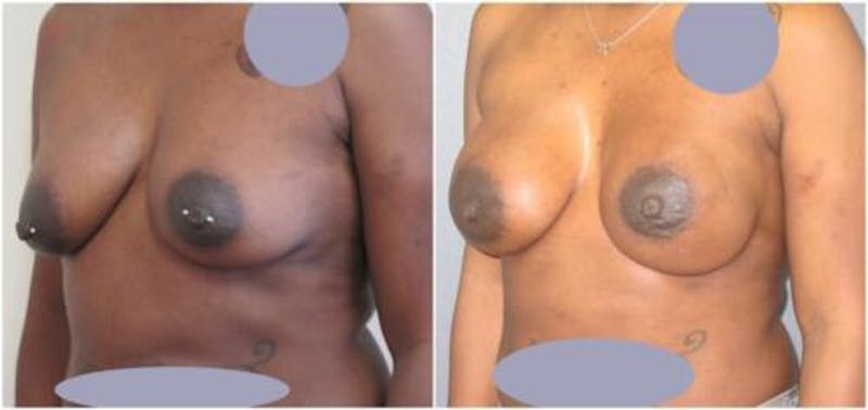 Breast Reconstruction Before & After Gallery - Patient 187840 - Image 3