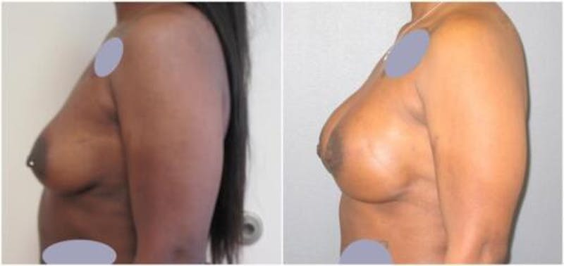 Breast Reconstruction Before & After Gallery - Patient 187840 - Image 4