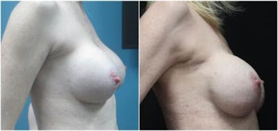 Breast Reconstruction Before & After Gallery - Patient 218539 - Image 1