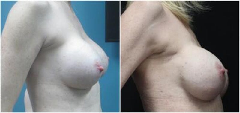 Breast Reconstruction Before & After Gallery - Patient 218539 - Image 1