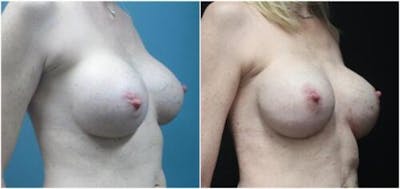 Breast Reconstruction Before & After Gallery - Patient 218539 - Image 2