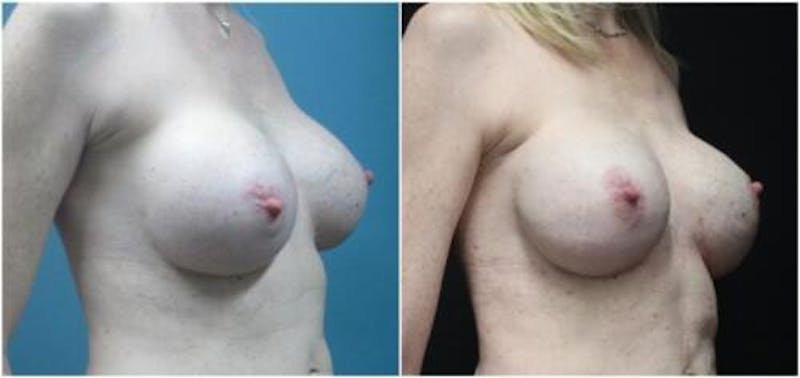 Breast Reconstruction Before & After Gallery - Patient 218539 - Image 2