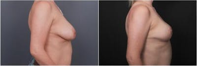 Breast Reduction Before & After Gallery - Patient 898861 - Image 1