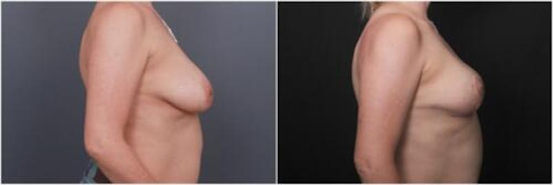 Breast Reduction Before & After Gallery - Patient 898861 - Image 1