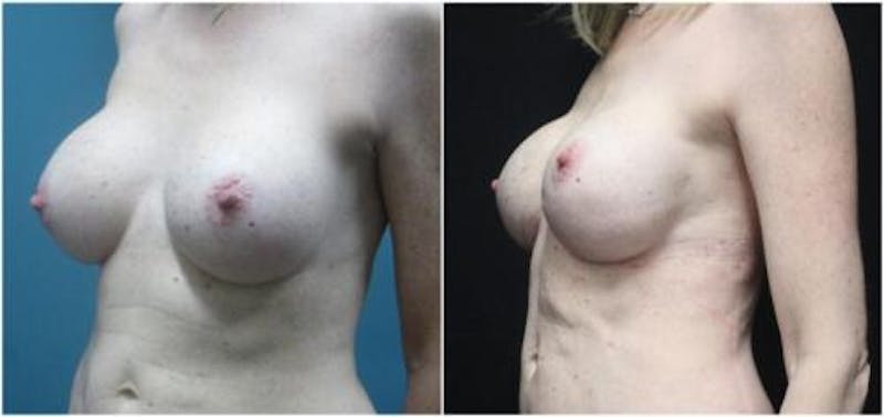 Breast Reconstruction Before & After Gallery - Patient 218539 - Image 3