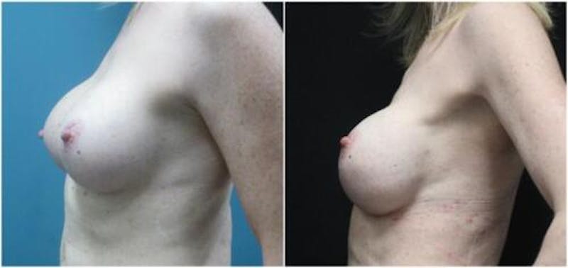 Breast Reconstruction Before & After Gallery - Patient 218539 - Image 4