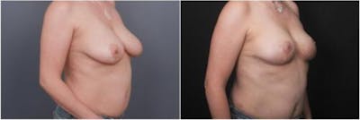 Breast Reduction Before & After Gallery - Patient 898861 - Image 2