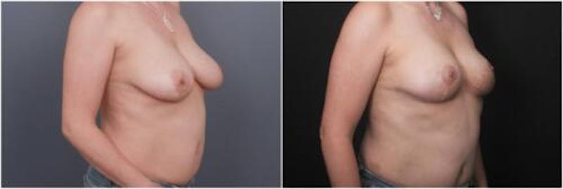 Breast Reduction Before & After Gallery - Patient 898861 - Image 2