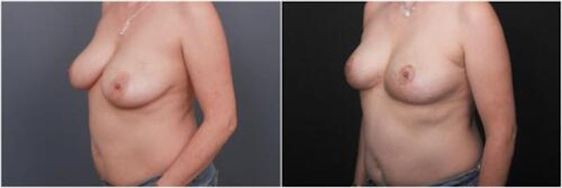 Breast Reduction Before & After Gallery - Patient 898861 - Image 3