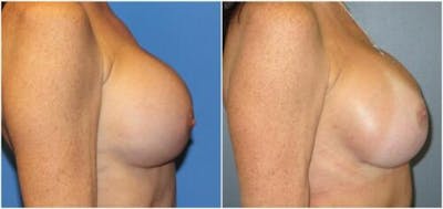 Breast Reconstruction Before & After Gallery - Patient 150089 - Image 1
