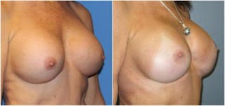 Breast Reconstruction Before & After Gallery - Patient 150089 - Image 2